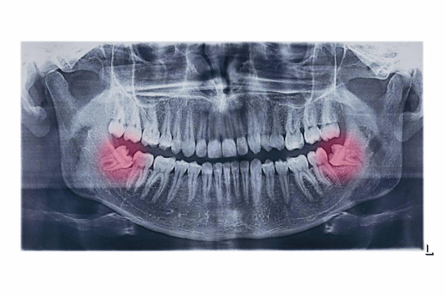 Dents de sagesse